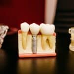 הליך השתלת שיניים בעיצומו בטורקיה, הידוע במצוינות האסתטית הדנטלית שלו.