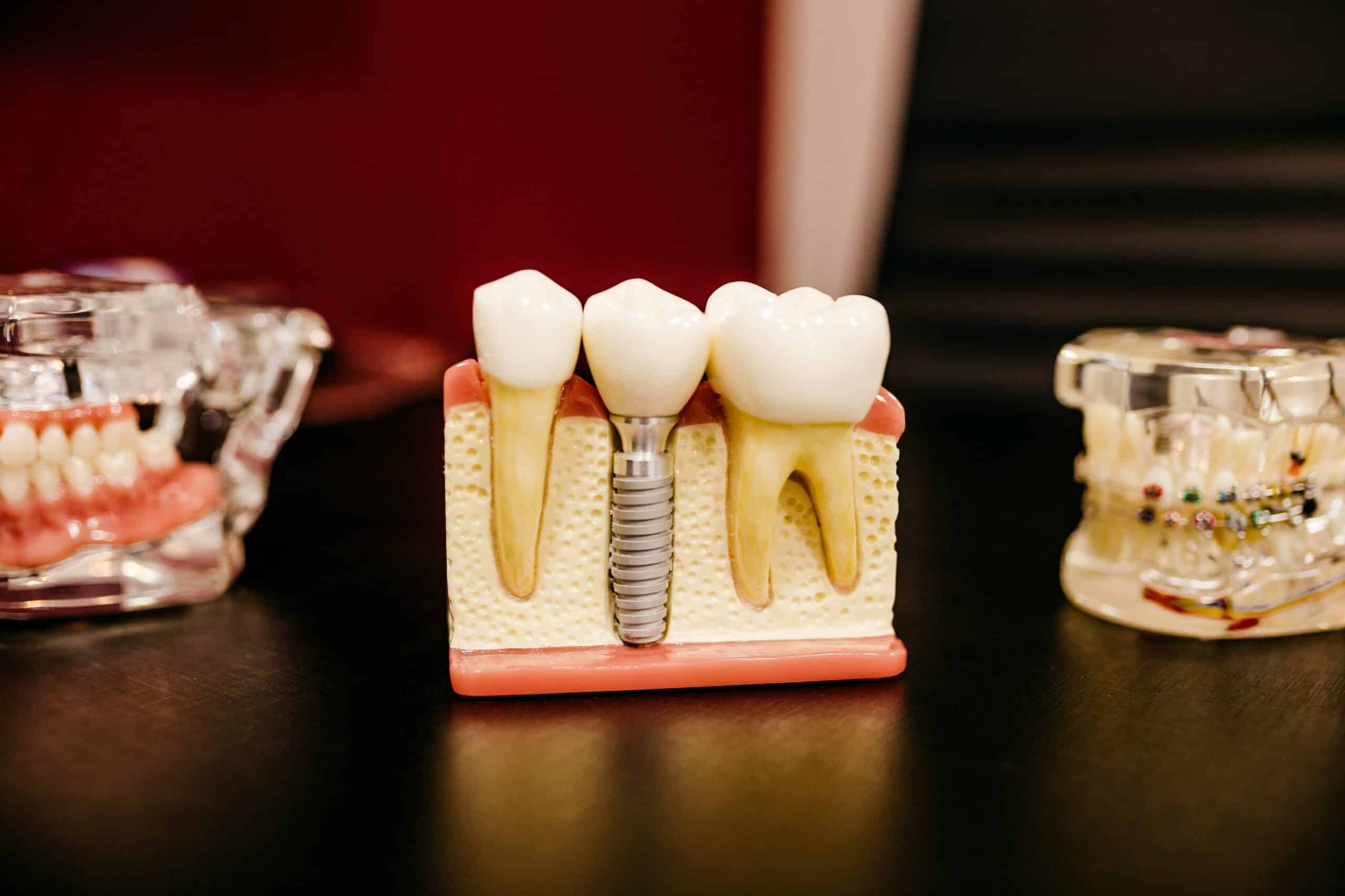 הליך השתלת שיניים בעיצומו בטורקיה, הידוע במצוינות האסתטית הדנטלית שלו.