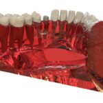 השתלות שיניים ללא כאב