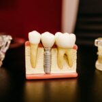 השתלות שיניים בשיטה הבסיסית ממזערות את אובדן העצם ומבטיחות תוצאות ארוכות טווח עם מינימום אי נוחות.