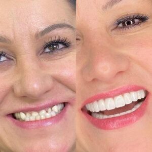 כתרי זירקוניה הם בעלי מראה טבעי דמוי שן, מה שהופך אותם לבחירה פופולרית עבור אנשים המחפשים חיוך חלק.