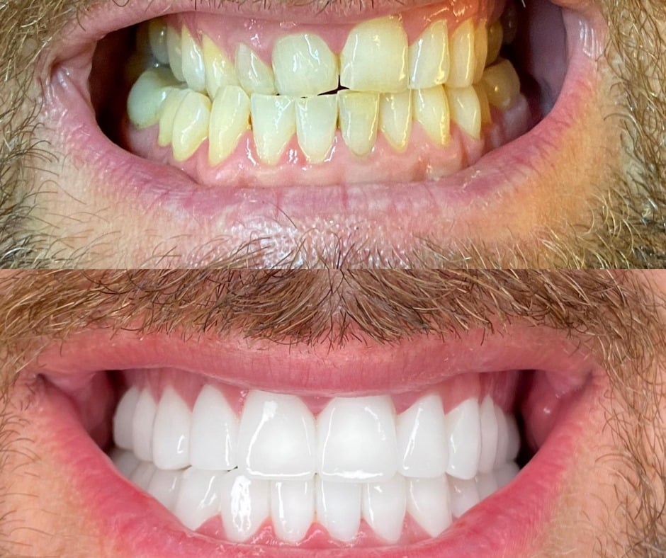 כתרי זירקוניה הם שחזורי שיניים העשויים מחומר חזק ועמיד הנקרא זירקוניום דו חמצני.