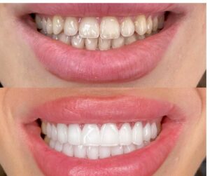 הודות להתקדמות הטכנולוגיה, ניתן להתאים כתרי זירקוניה בצורה מדויקת להתאמה לצבע ולצורה של השיניים הסמוכות.