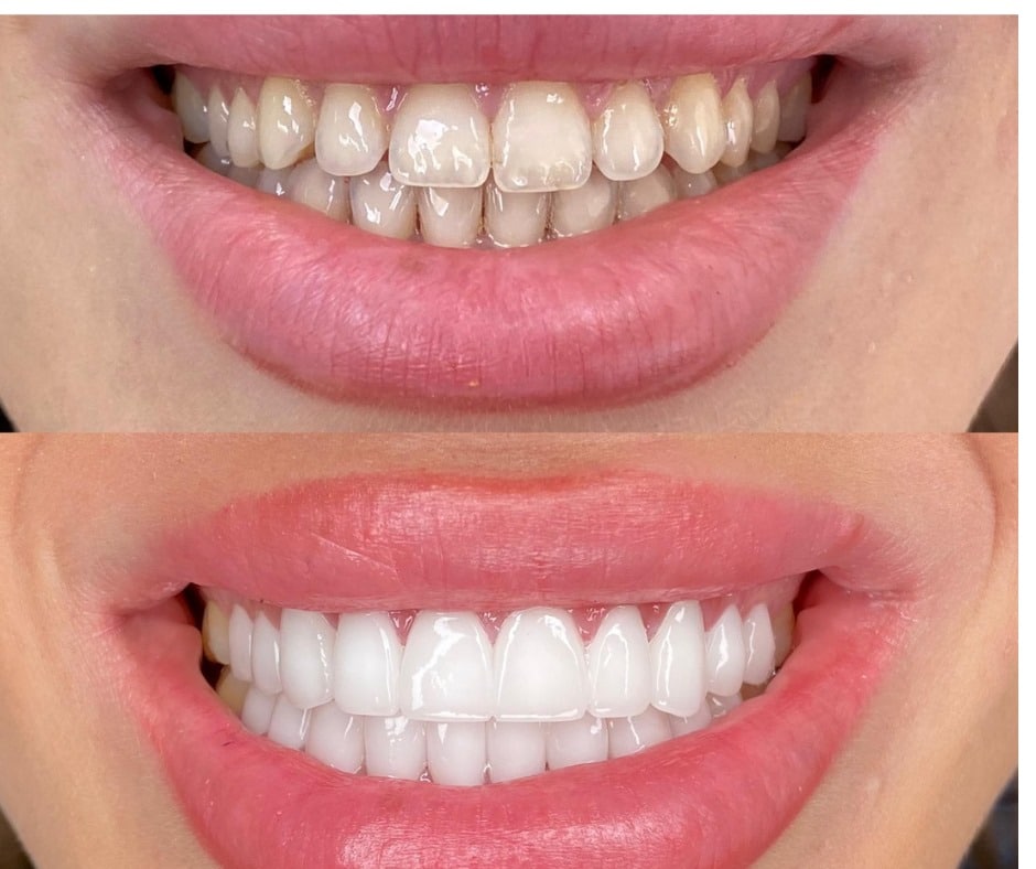 הודות להתקדמות הטכנולוגיה, ניתן להתאים כתרי זירקוניה בצורה מדויקת להתאמה לצבע ולצורה של השיניים הסמוכות.