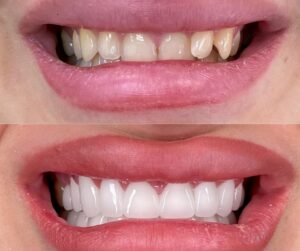 כתרי זירקוניה הם סוג של כתר דנטלי המציע חוזק ועמידות מעולים, מה שהופך אותם לאידיאליים לשיקום שיניים פגועות או עששות.