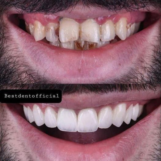כתרי זירקוניה דורשים פחות צמצום שיניים בהשוואה לסוגים אחרים של כתרים, ומשמרים יותר ממבנה השיניים הטבעי.