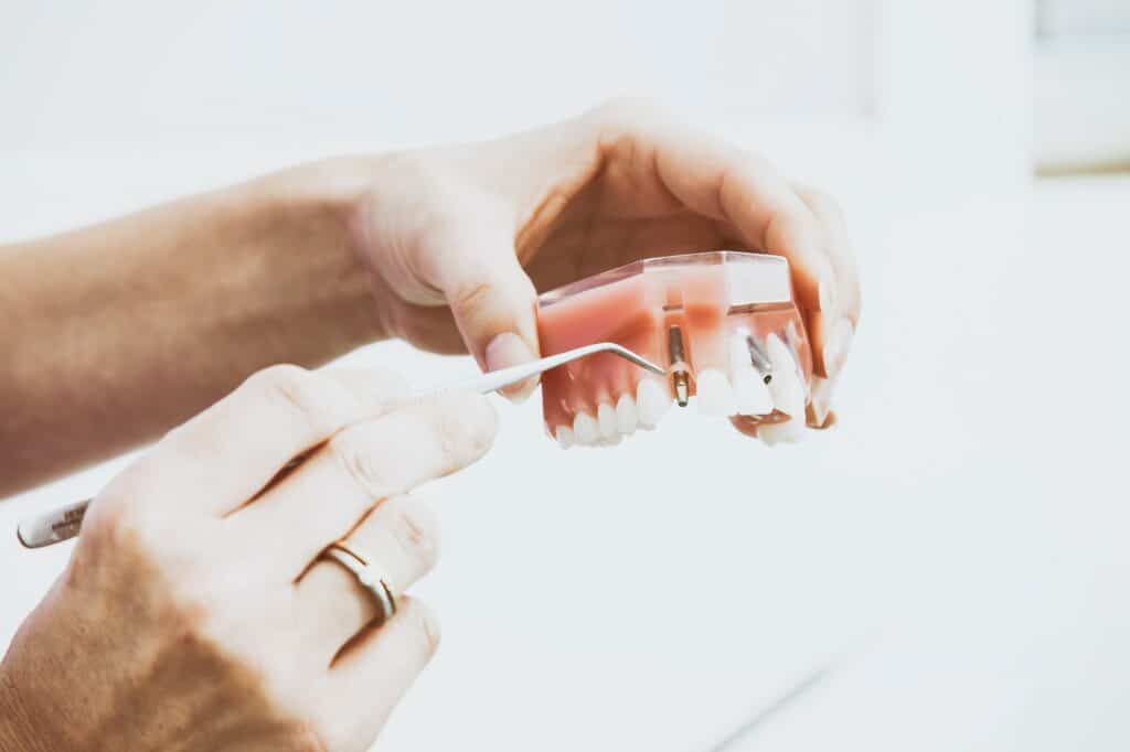 ציפוי שיניים למניעת בריחות על שיני מולר.